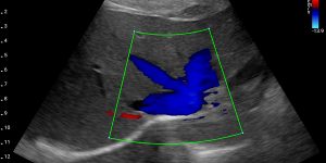 Liver Transverse - Color Doppler