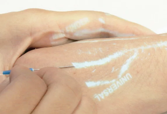 Venipuncture using a vein finder