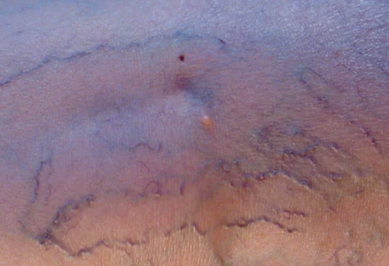 Vascular procedures with vein finder